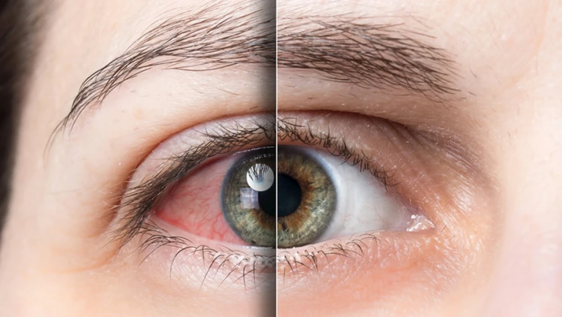 Uzman isimden 'göz tansiyonu' için erken tedavi uyarısı