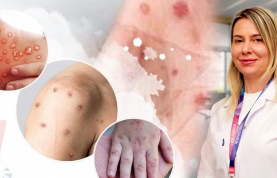 Maymun çiçeğinde bağışıklık sistemi uyarısı