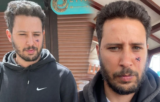 Oyuncu Tuan Tunalı'nın yüzünü köpek ısırdı