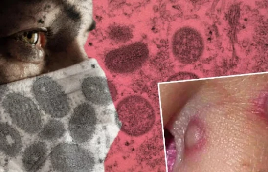 Sağlık Bakanlığı açıkladı! 'Maymun çiçeği' virüsü Türkiye'de görüldü mü?