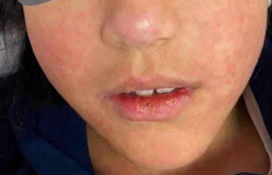 Yıllardır görülmüyordu! Kızamık vakaları yeniden ortaya çıktı!